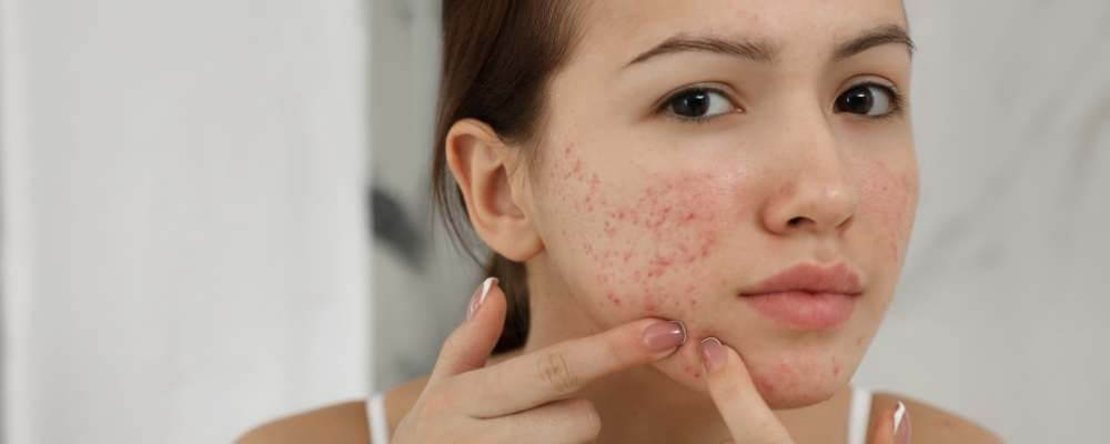 Do you have a hormonal teenager with acne?