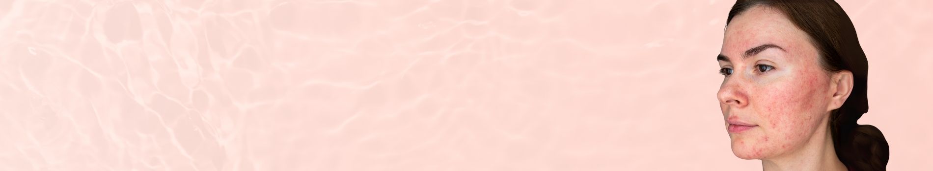 Skin Concern Rosacea & Redness
