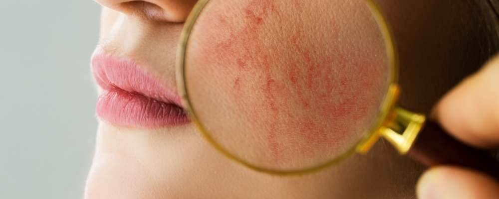 All about rosacea – top 5 symptoms + 15 common triggers