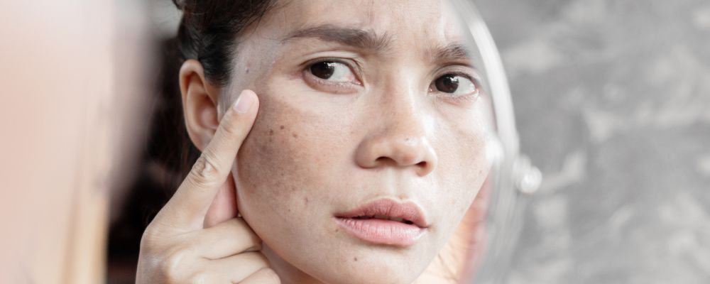 Facts About Skin Discoloration