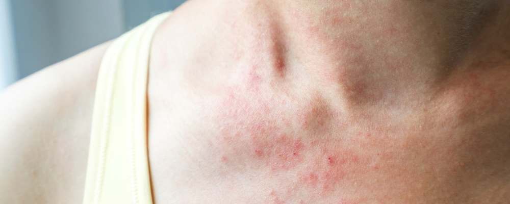 5 steps to stop eczema from controlling your life