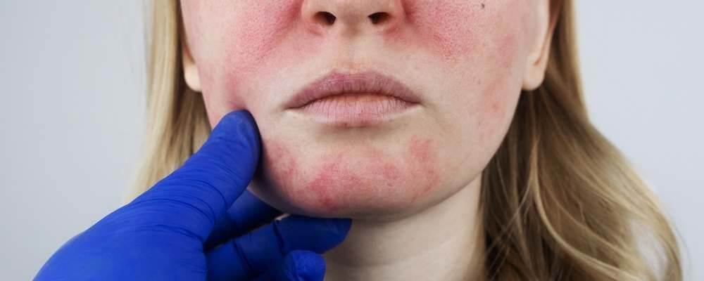 skincare tips for rosacea