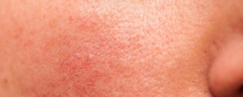 6 Unbelievable Facts About How Inflammation Damages Your Skin 