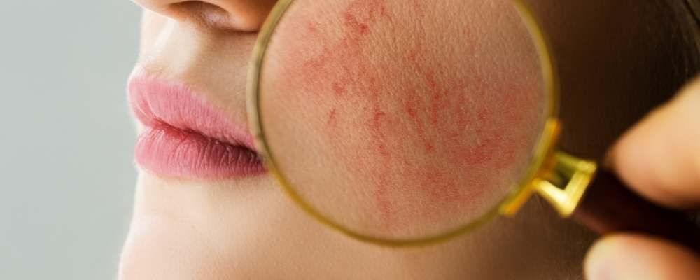 All about rosacea – top 5 symptoms + 15 common triggers