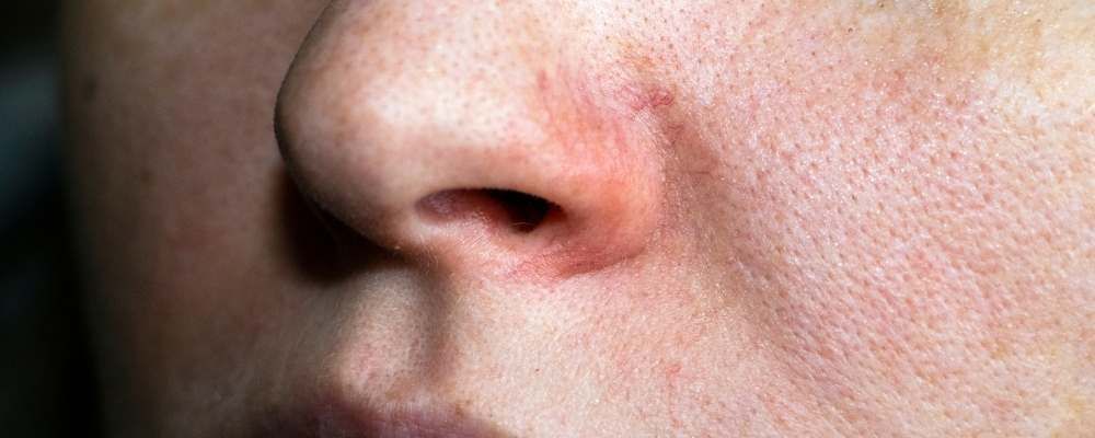 Best treatments for clogged pores