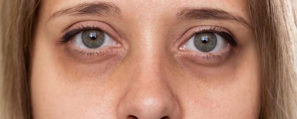 Eye care 101: fine lines + dark circles
