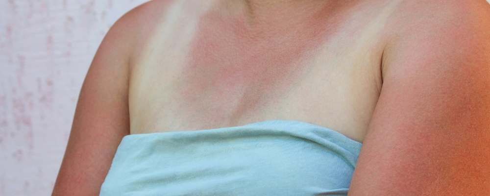 Most common summer skin care mistakes