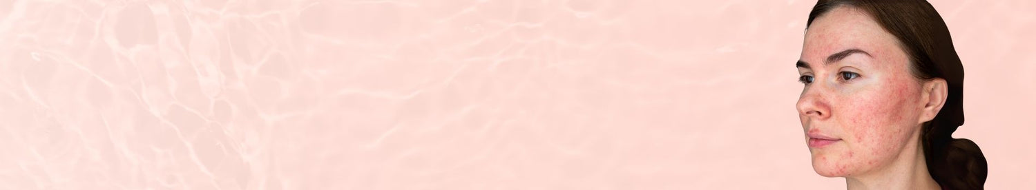 Skin Concern Rosacea &amp; Redness